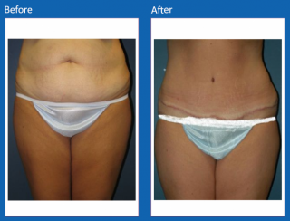 tummy-tuck-40