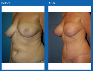 tummy-tuck-41