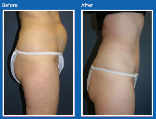 tummy-tuck-42