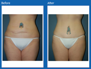 tummy-tuck-43