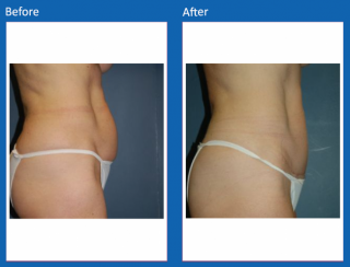 tummy-tuck-44