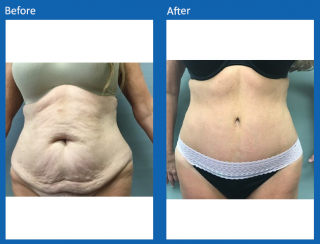 tummy-tuck-5