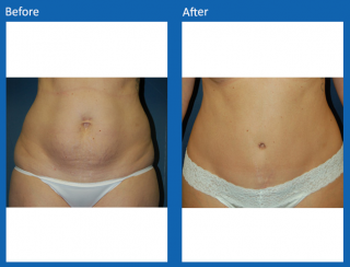tummy-tuck-6