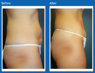 tummy-tuck-7