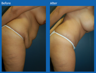 tummy-tuck-8