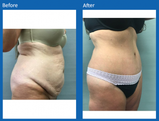 tummy-tuck-9