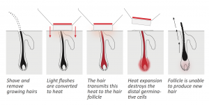 Hair Removal Cycle