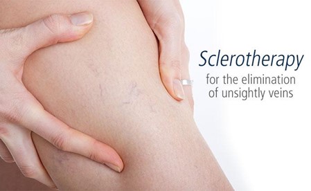 Sclerotherapy